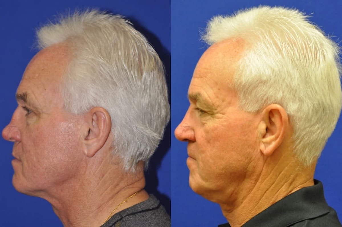 Revision Rhinoplasty Before & After Gallery - Patient 333578 - Image 5