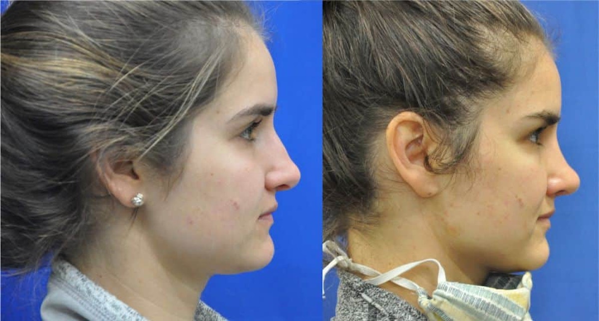Revision Rhinoplasty Before & After Gallery - Patient 886224 - Image 3