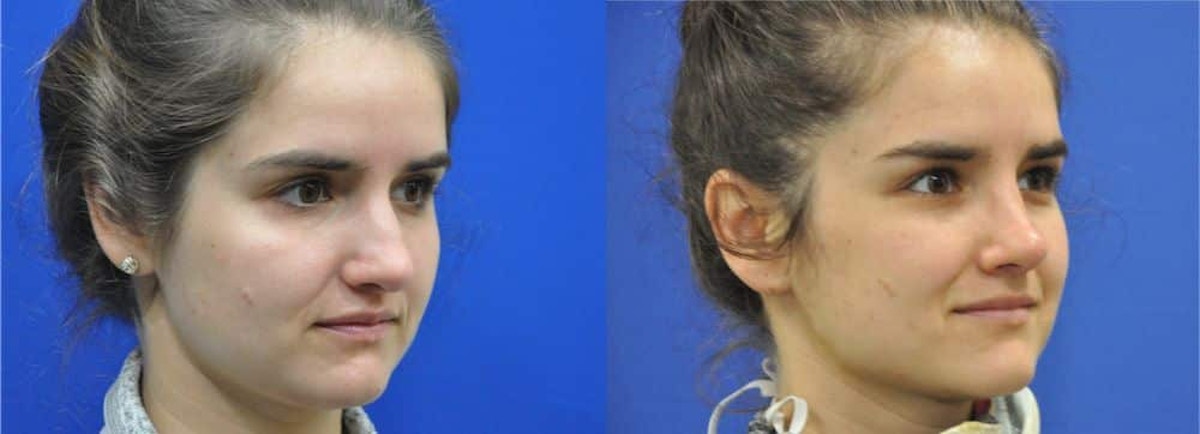 Revision Rhinoplasty Before & After Gallery - Patient 886224 - Image 4