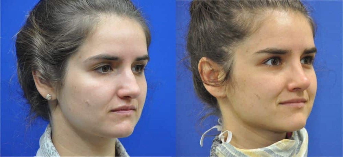 Revision Rhinoplasty Before & After Gallery - Patient 886224 - Image 5