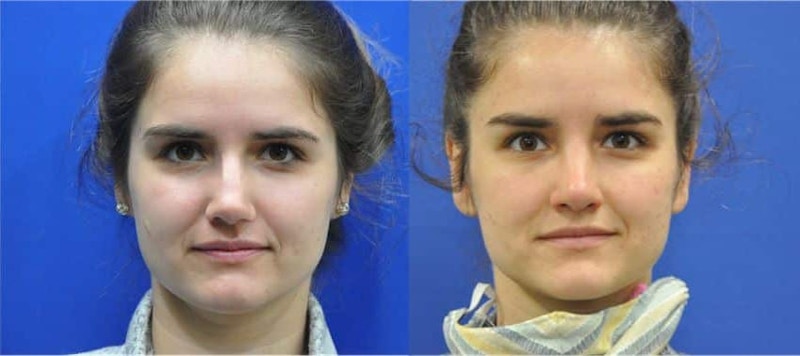 Revision Rhinoplasty Before & After Gallery - Patient 886224 - Image 1