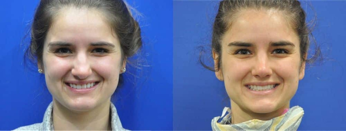 Revision Rhinoplasty Before & After Gallery - Patient 886224 - Image 2