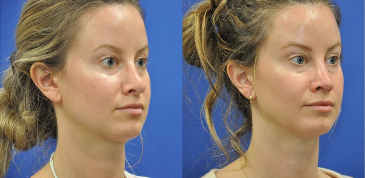Revision Rhinoplasty Before & After Gallery - Patient 313606 - Image 2