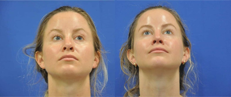 Revision Rhinoplasty Before & After Gallery - Patient 313606 - Image 1