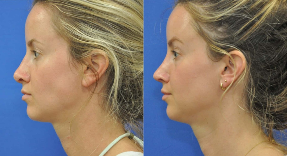 Revision Rhinoplasty Before & After Gallery - Patient 313606 - Image 3