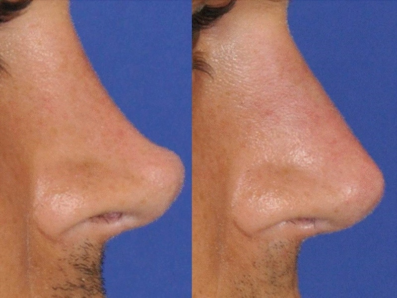 Non-Surgical Rhinoplasty Before & After Gallery - Patient 299171 - Image 1