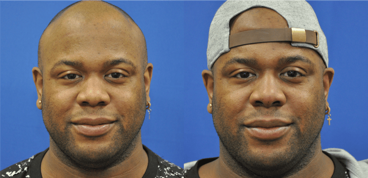 Non-Surgical Rhinoplasty Before & After Gallery - Patient 362663 - Image 3