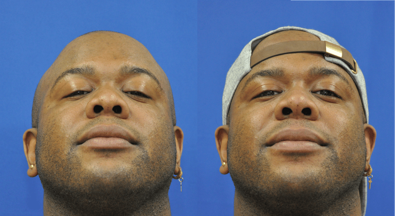 Non-Surgical Rhinoplasty Before & After Gallery - Patient 362663 - Image 1
