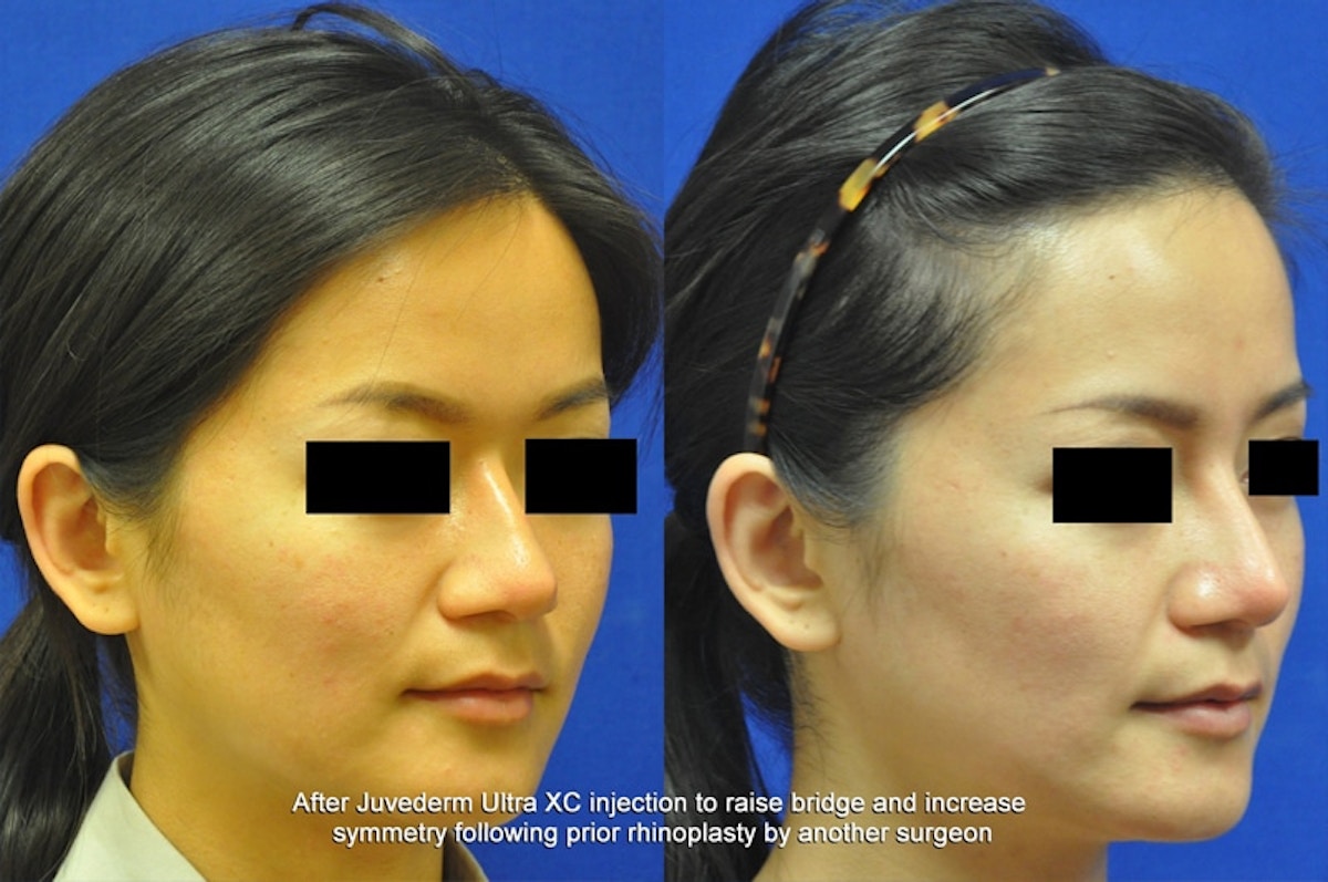 Non-Surgical Rhinoplasty Before & After Gallery - Patient 342894 - Image 2