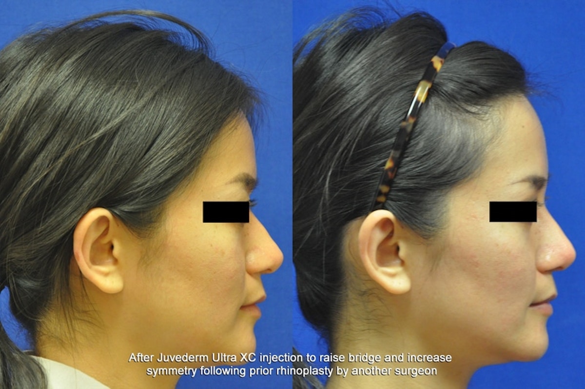 Non-Surgical Rhinoplasty Before & After Gallery - Patient 342894 - Image 3
