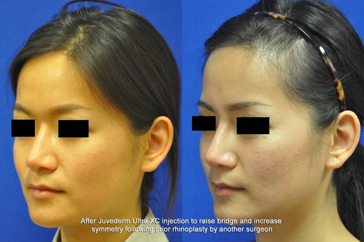 Non-Surgical Rhinoplasty Before & After Gallery - Patient 342894 - Image 4