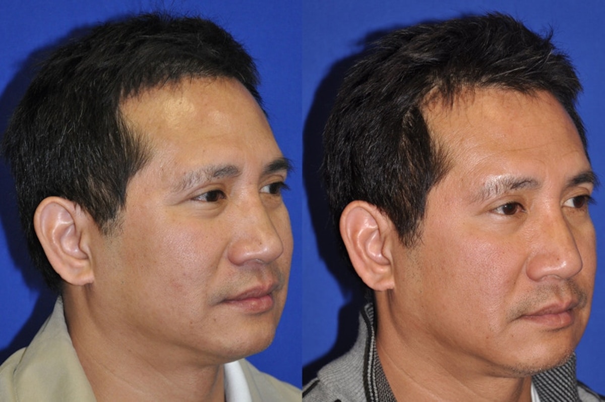 Non-Surgical Rhinoplasty Before & After Gallery - Patient 274100 - Image 2