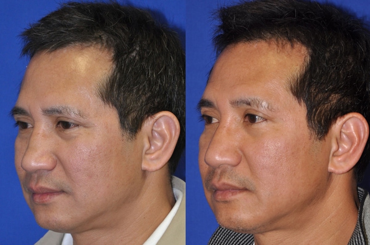 Non-Surgical Rhinoplasty Before & After Gallery - Patient 274100 - Image 5