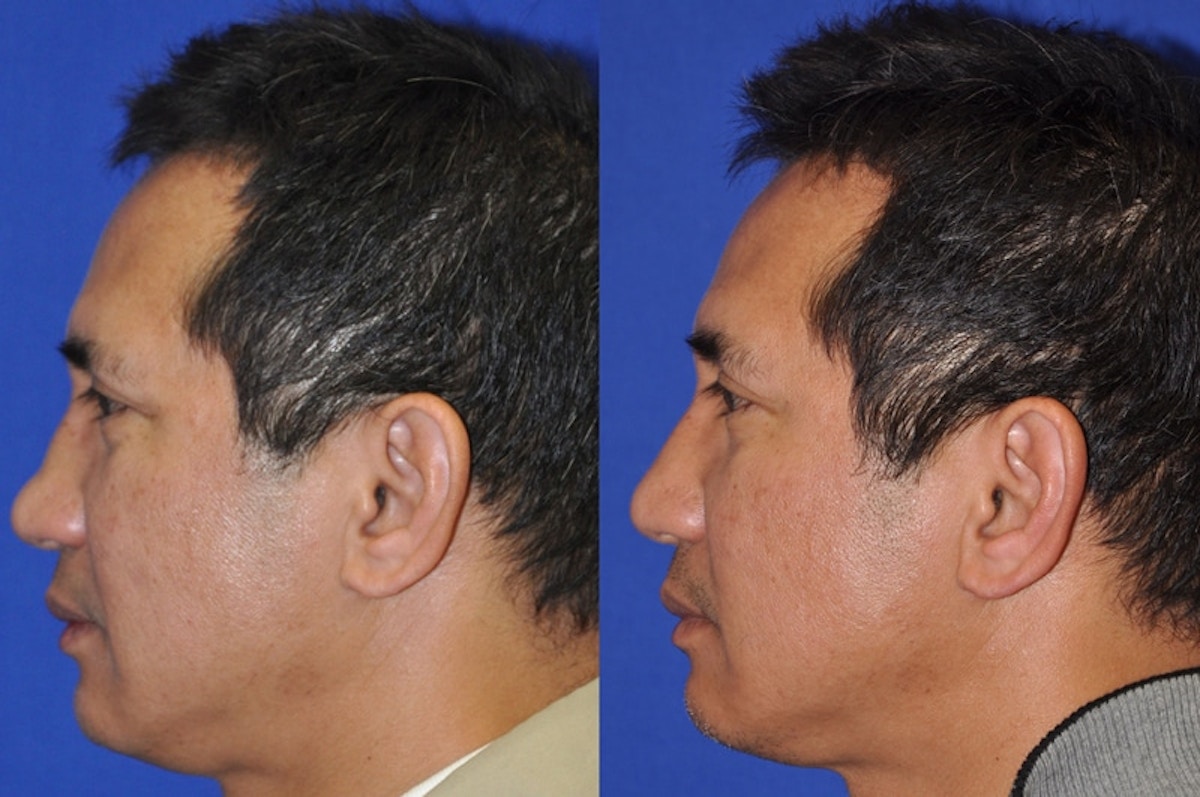 Non-Surgical Rhinoplasty Before & After Gallery - Patient 274100 - Image 4