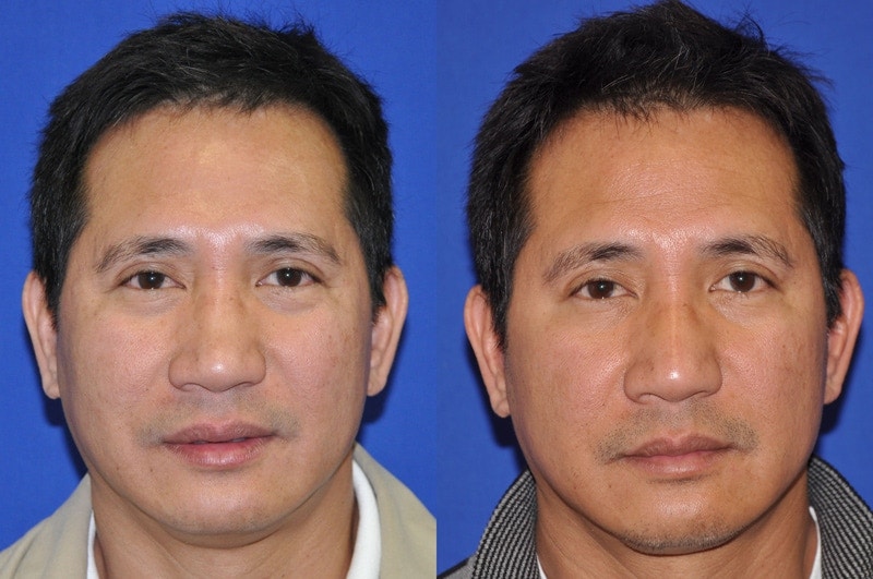 Non-Surgical Rhinoplasty Before & After Gallery - Patient 274100 - Image 1
