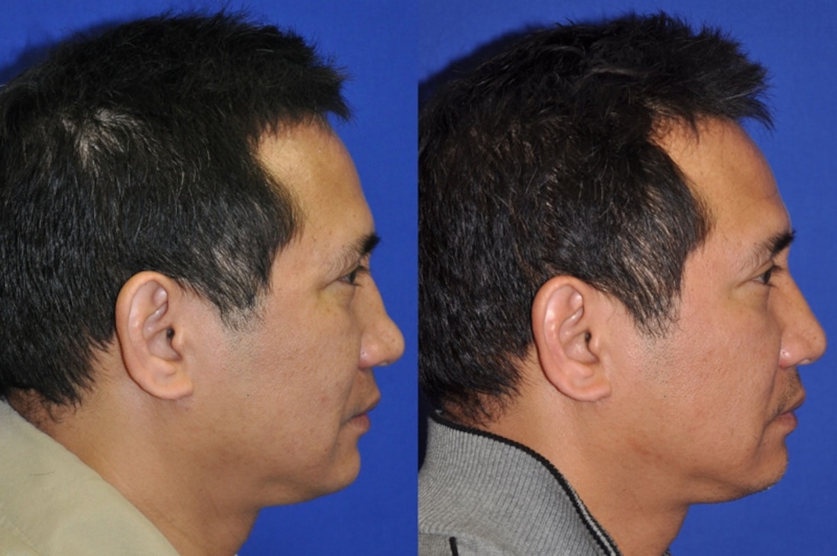 Non-Surgical Rhinoplasty Before & After Gallery - Patient 274100 - Image 3