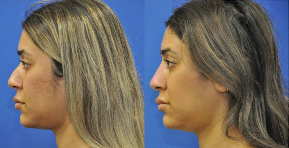 Non-Surgical Rhinoplasty Before & After Gallery - Patient 213657 - Image 3