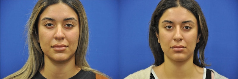 Non-Surgical Rhinoplasty Before & After Gallery - Patient 213657 - Image 1