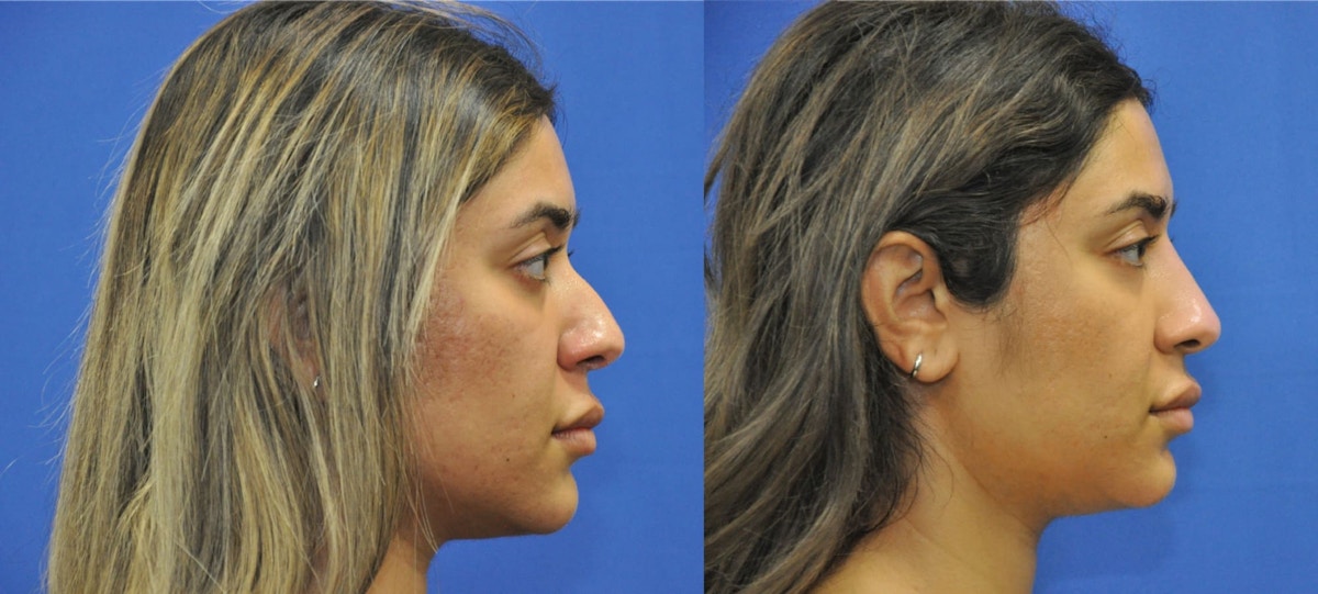 Non-Surgical Rhinoplasty Before & After Gallery - Patient 213657 - Image 5