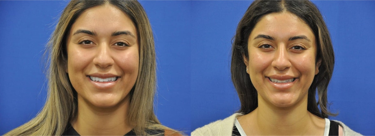 Non-Surgical Rhinoplasty Before & After Gallery - Patient 213657 - Image 2