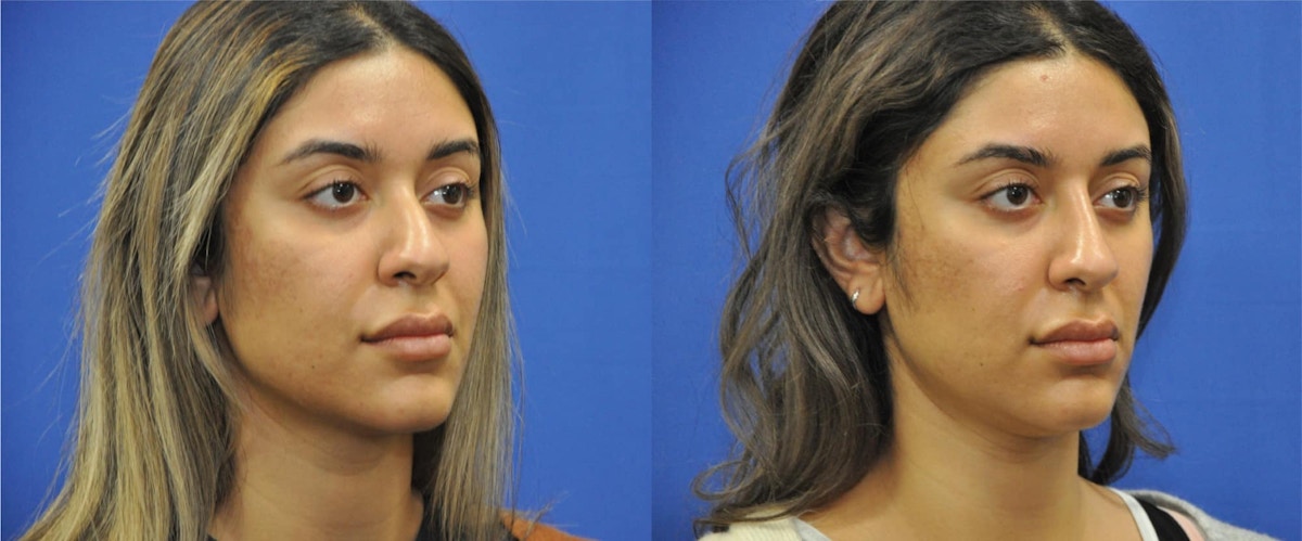 Non-Surgical Rhinoplasty Before & After Gallery - Patient 213657 - Image 6