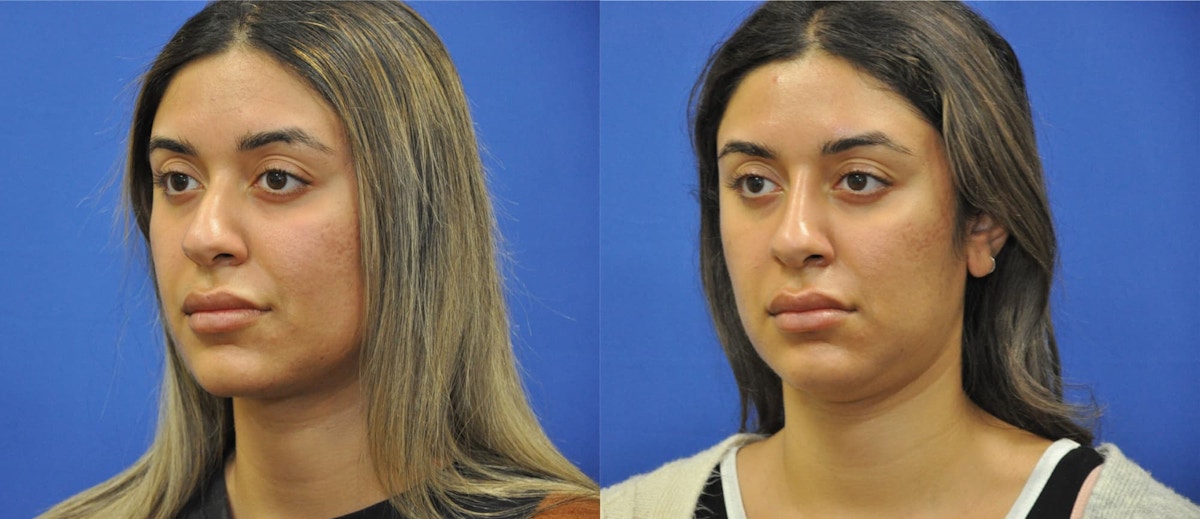 Non-Surgical Rhinoplasty Before & After Gallery - Patient 213657 - Image 4