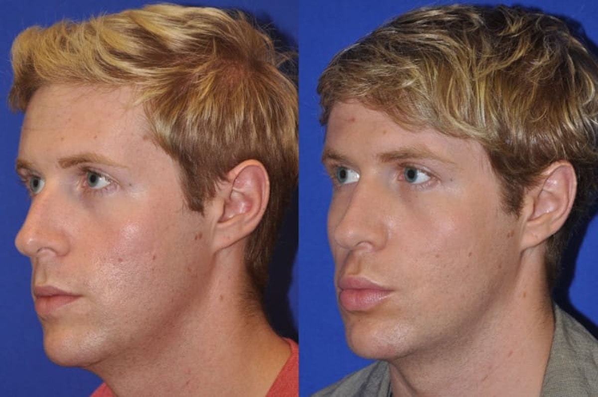 Endonasal Rhinoplasty Before & After Gallery - Patient 221427 - Image 7