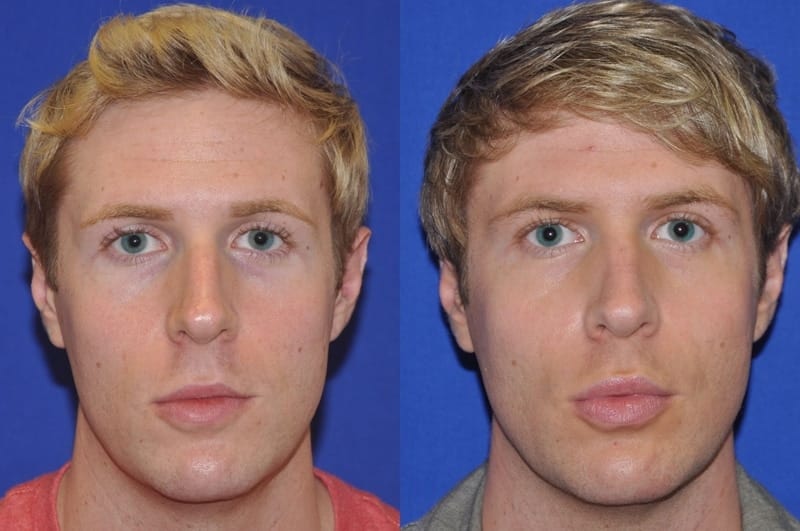 Endonasal Rhinoplasty Before & After Gallery - Patient 221427 - Image 1