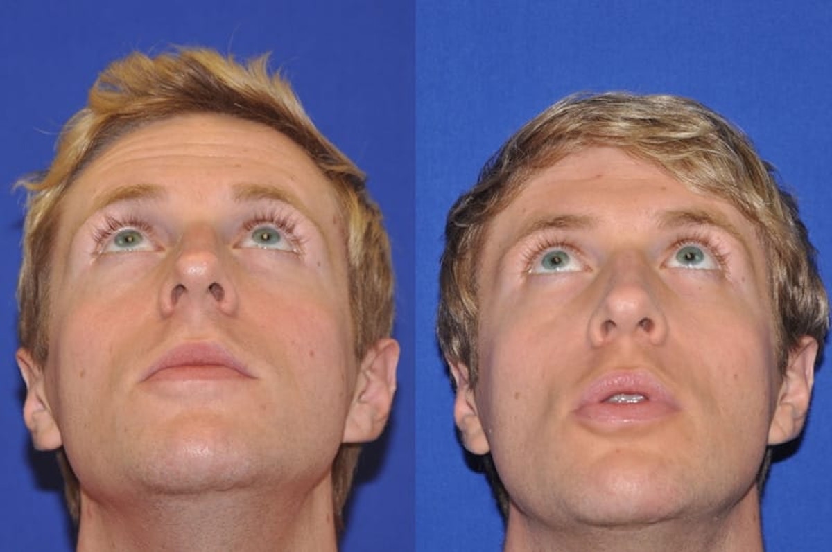 Endonasal Rhinoplasty Before & After Gallery - Patient 221427 - Image 2
