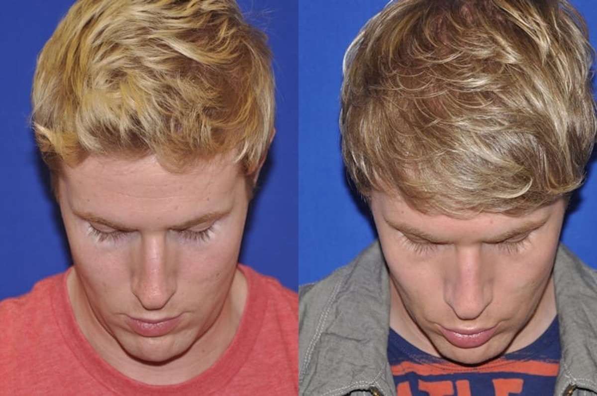 Endonasal Rhinoplasty Before & After Gallery - Patient 221427 - Image 3