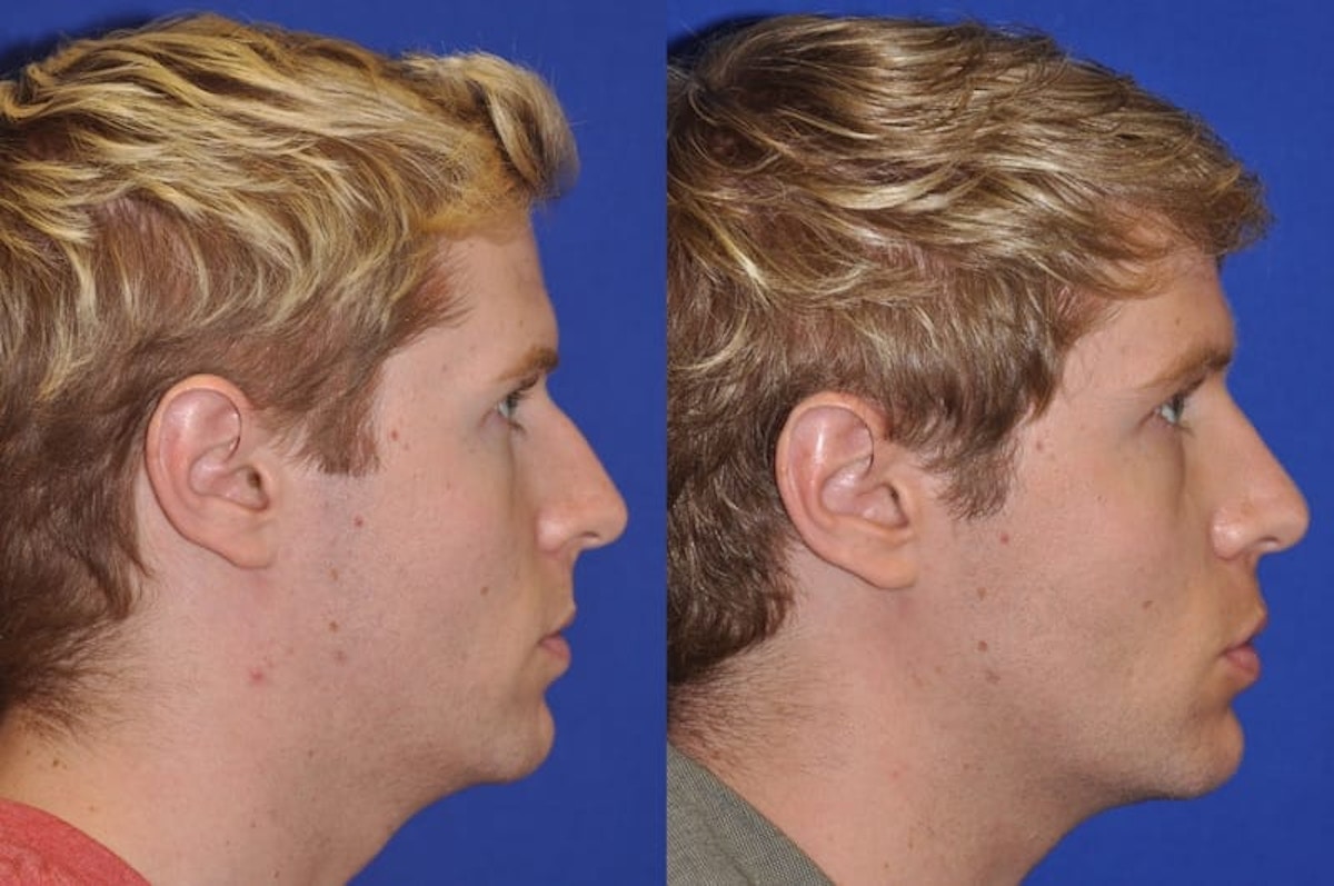 Endonasal Rhinoplasty Before & After Gallery - Patient 221427 - Image 4