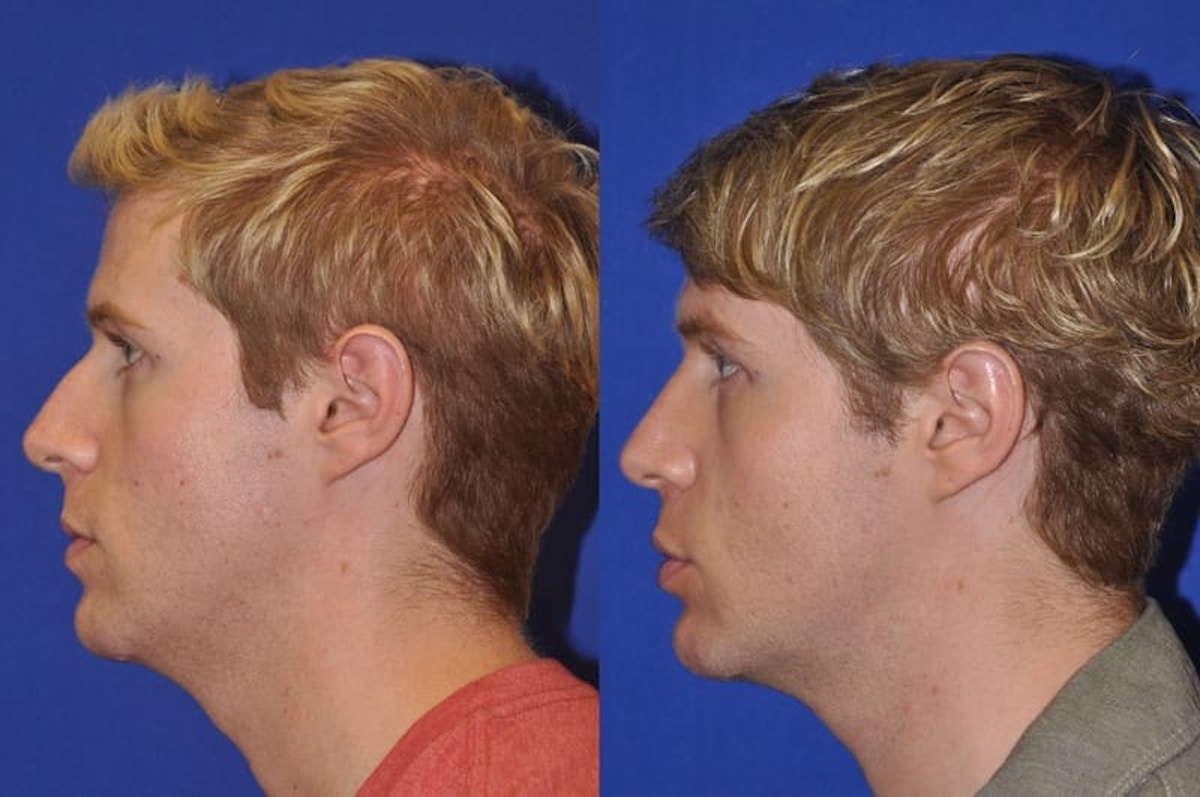 Endonasal Rhinoplasty Before & After Gallery - Patient 221427 - Image 6