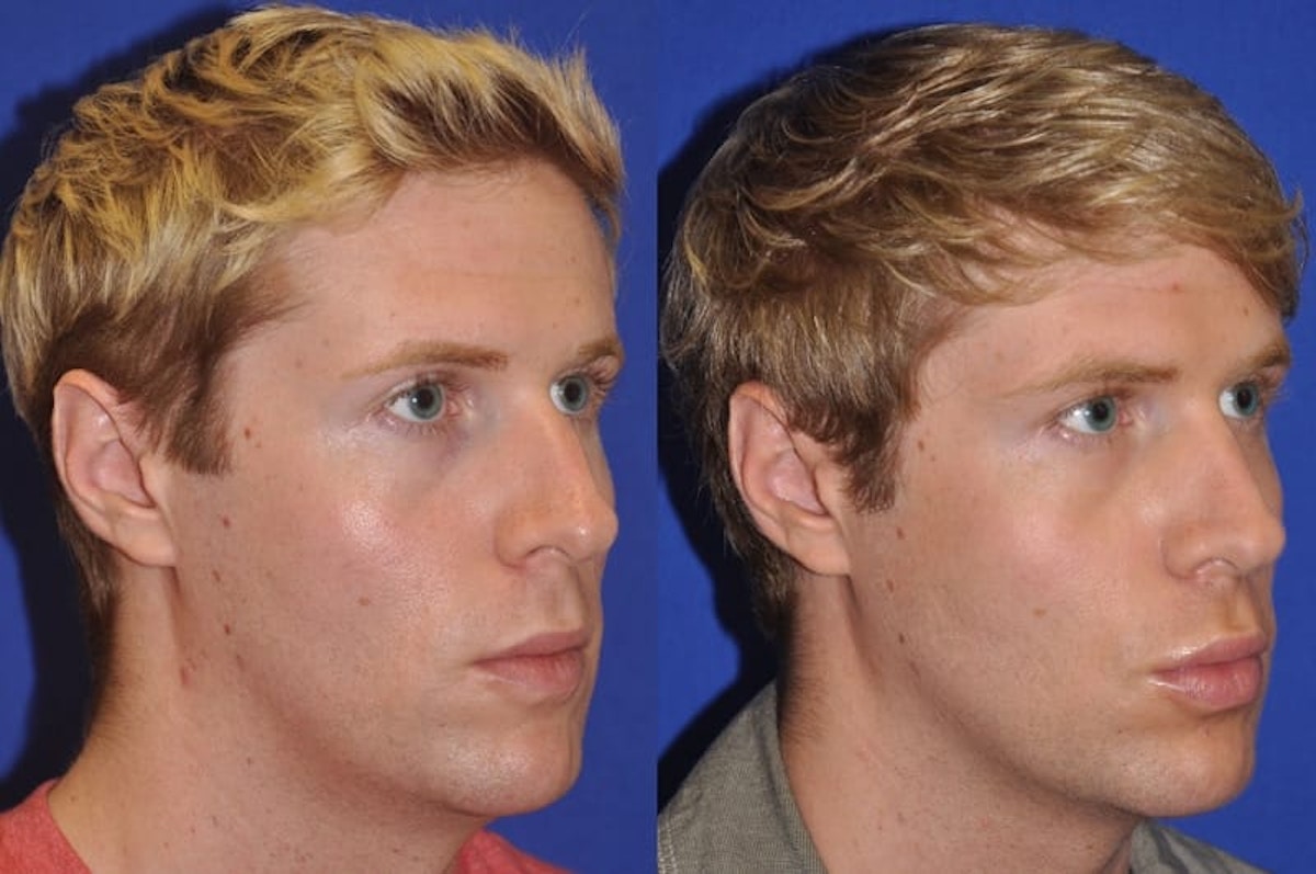 Endonasal Rhinoplasty Before & After Gallery - Patient 221427 - Image 5