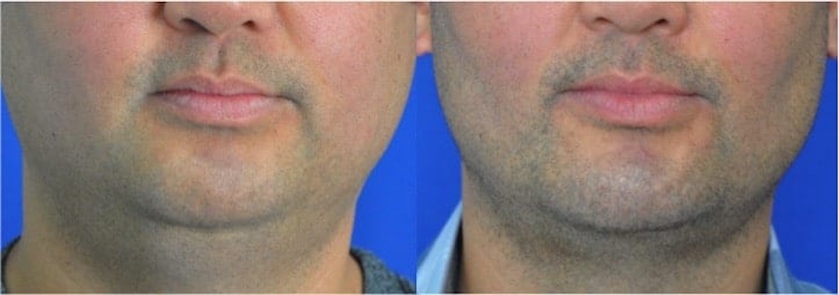 Chin Augmentation Before & After Gallery - Patient 131338 - Image 1