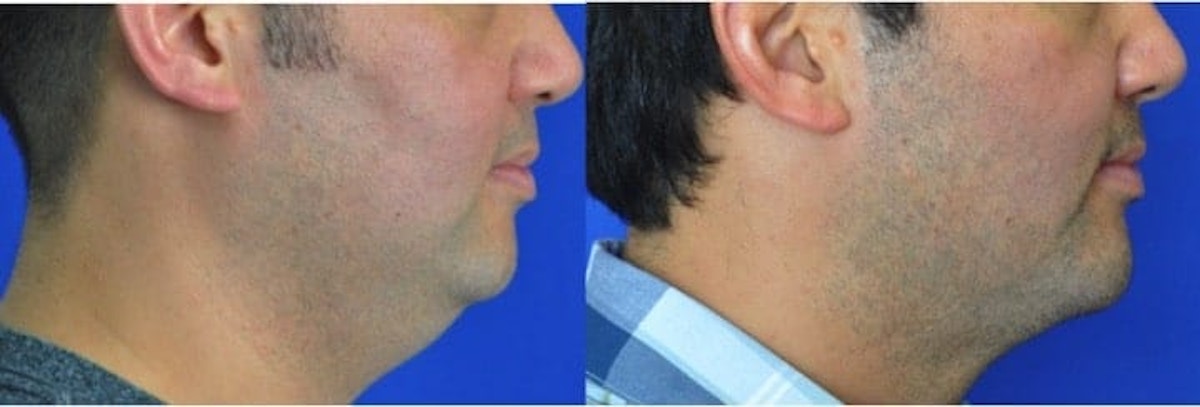 Chin Augmentation Before & After Gallery - Patient 131338 - Image 2