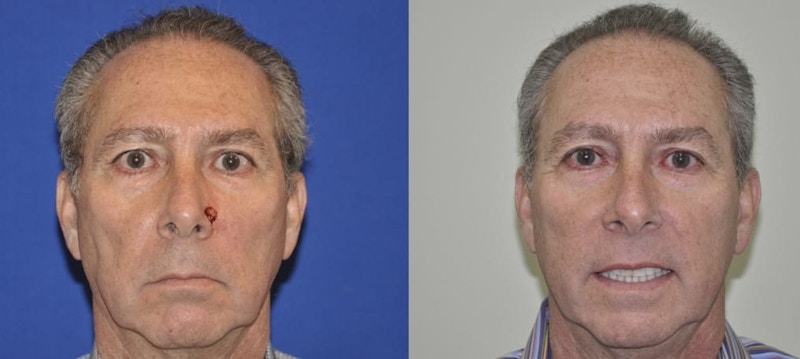 Skin Cancer Reconstruction Before & After Gallery - Patient 325412 - Image 1