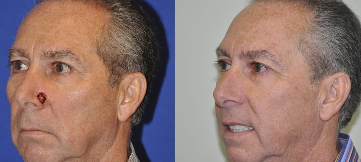 Skin Cancer Reconstruction Before & After Gallery - Patient 325412 - Image 2