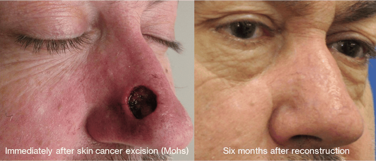 Skin Cancer Reconstruction Before & After Gallery - Patient 364283 - Image 2