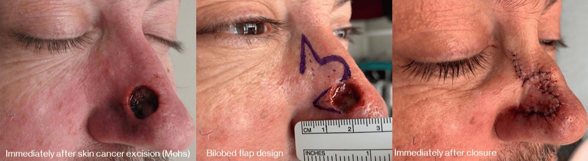 Skin Cancer Reconstruction Before & After Gallery - Patient 364283 - Image 1