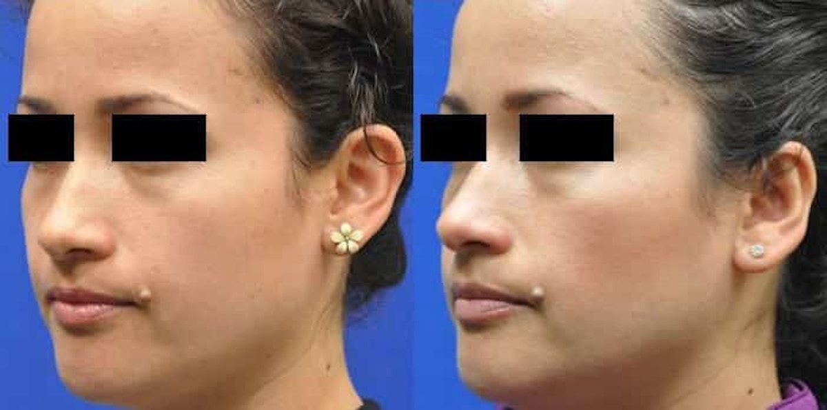 Otoplasty Before & After Gallery - Patient 170558 - Image 4