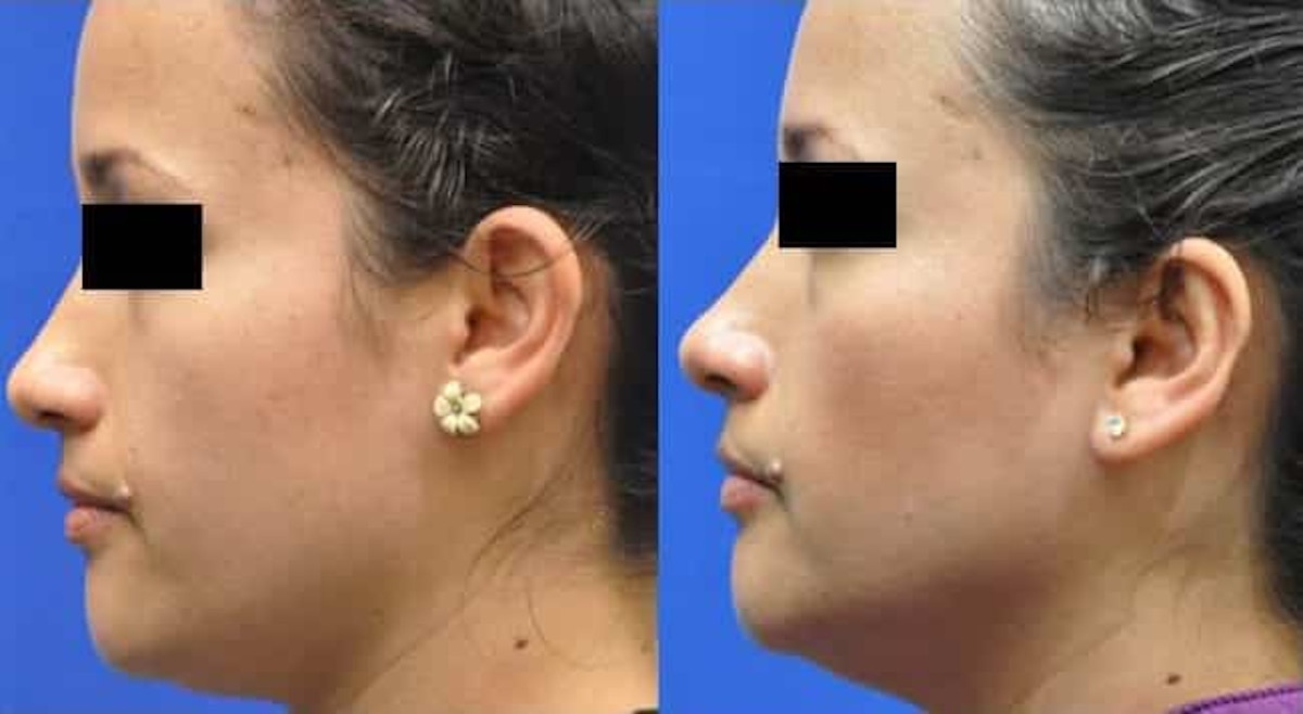 Otoplasty Before & After Gallery - Patient 170558 - Image 2