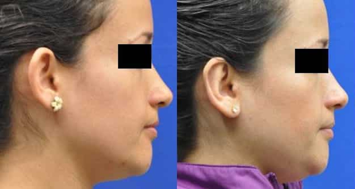 Otoplasty Before & After Gallery - Patient 170558 - Image 5