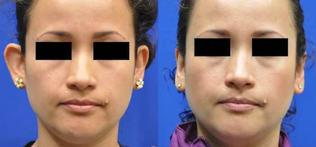 Otoplasty Before & After Gallery - Patient 170558 - Image 1
