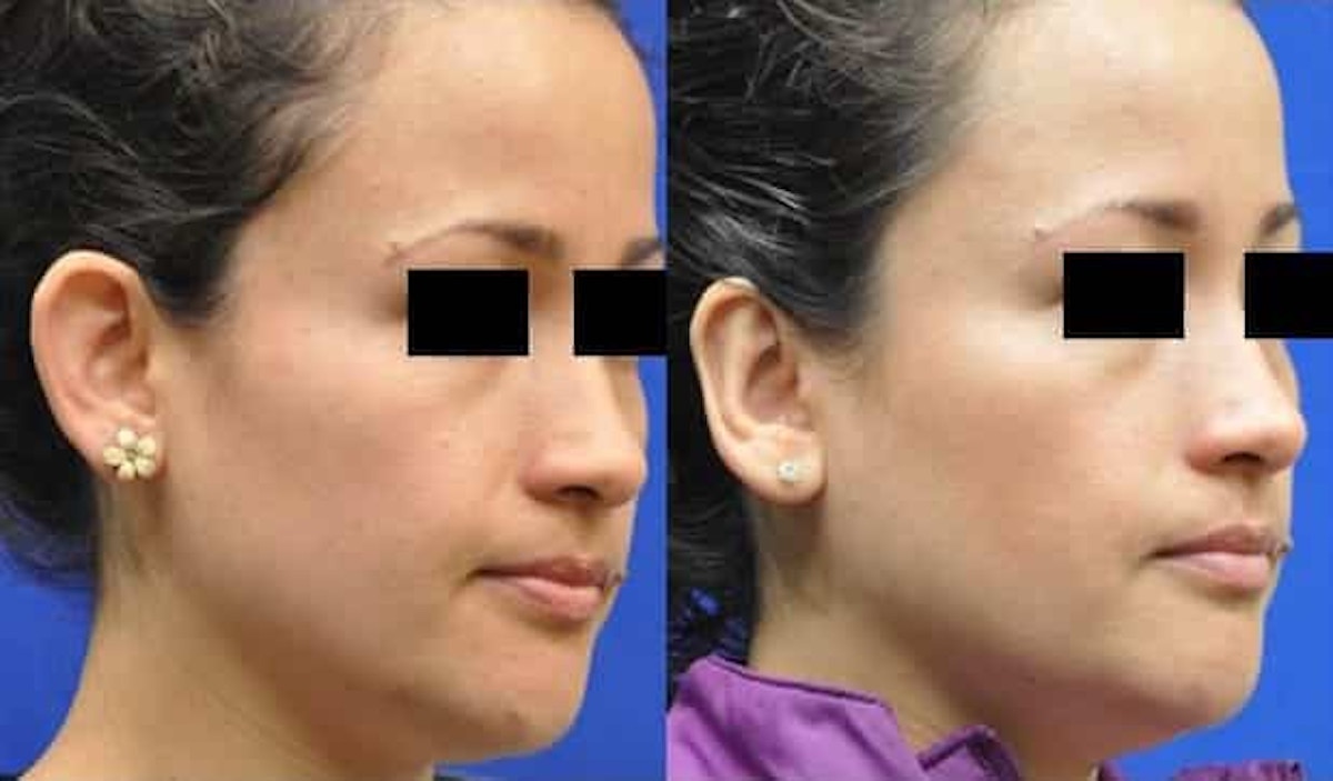Otoplasty Before & After Gallery - Patient 170558 - Image 3