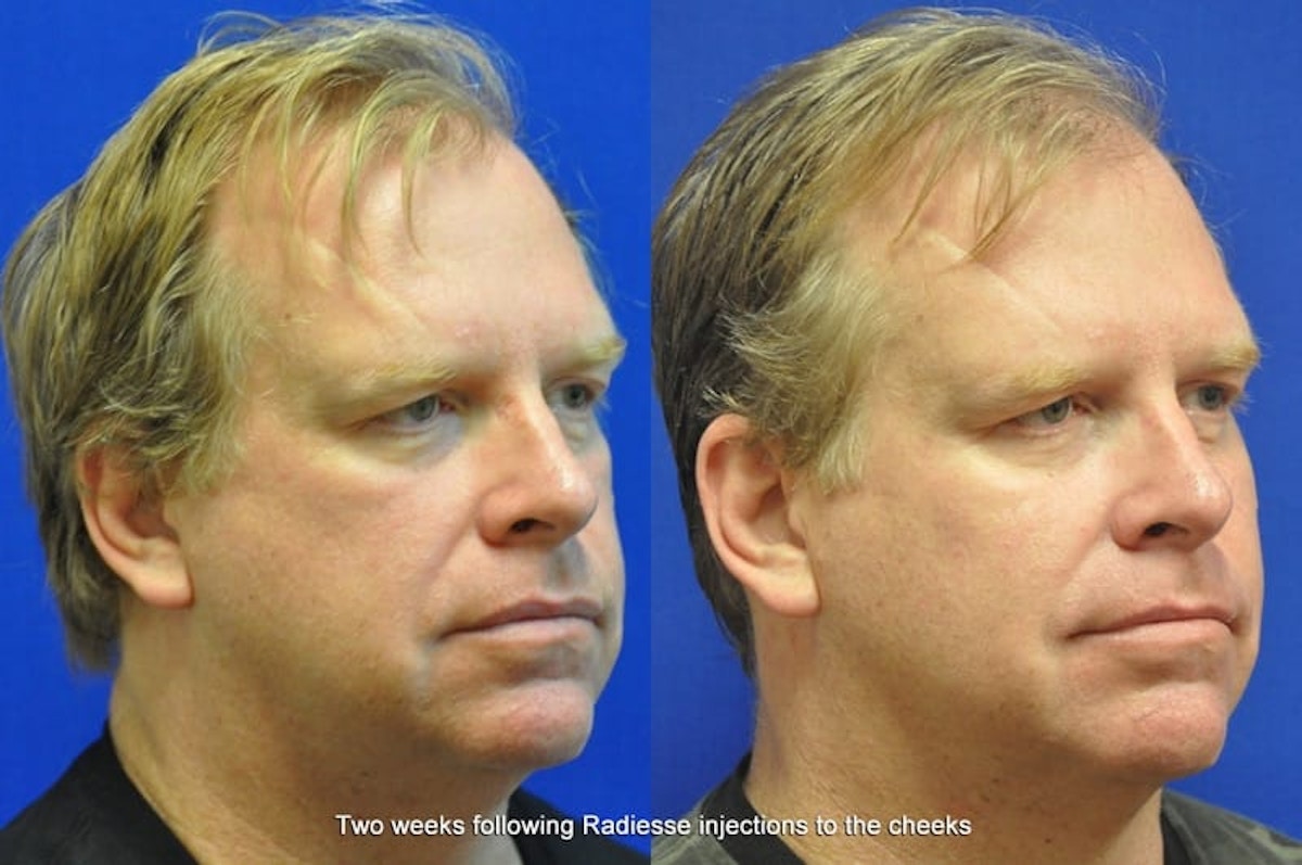 Dermal Fillers Before & After Gallery - Patient 114746 - Image 3