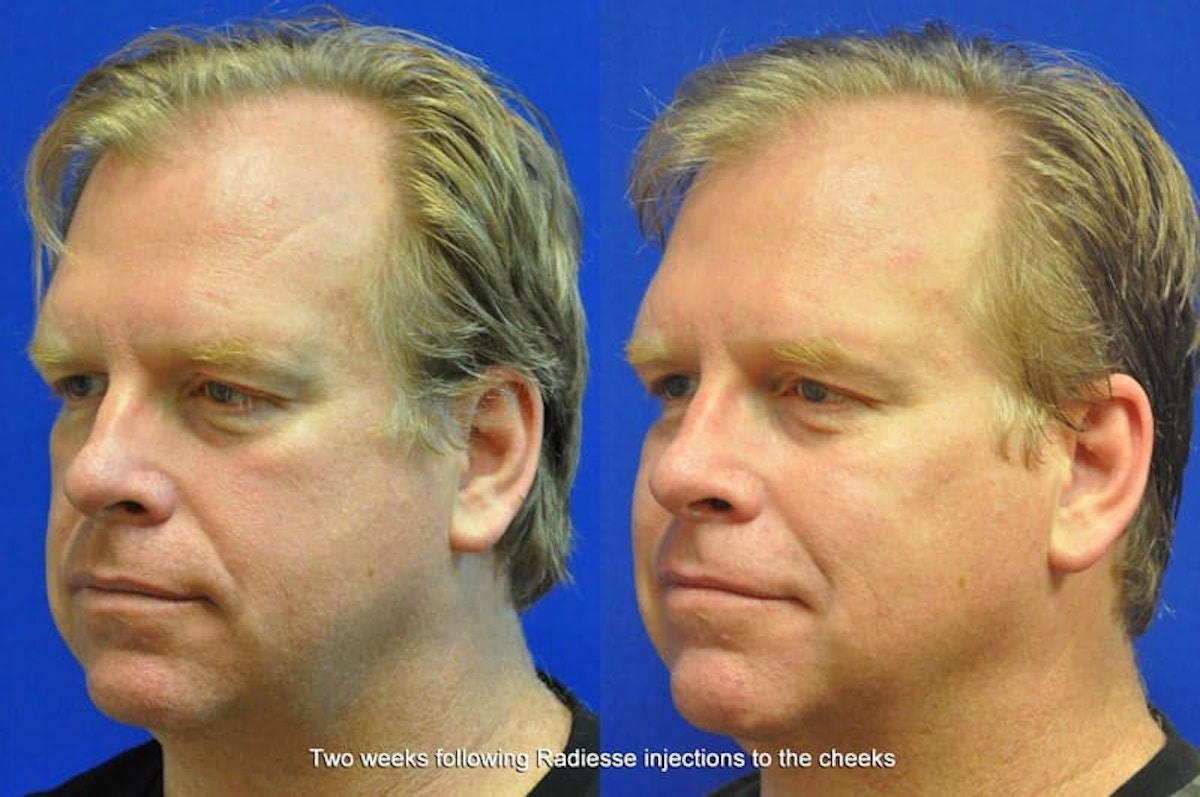 Dermal Fillers Before & After Gallery - Patient 114746 - Image 2