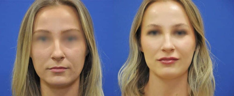 Lip Augmentation Before & After Gallery - Patient 376471 - Image 1