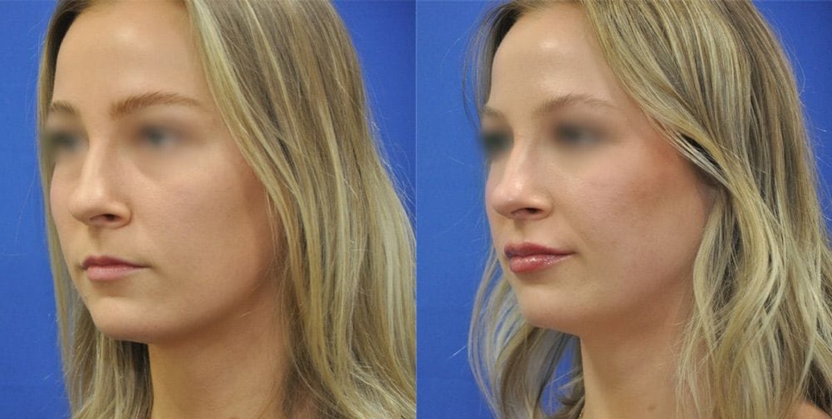 Lip Augmentation Before & After Gallery - Patient 376471 - Image 3