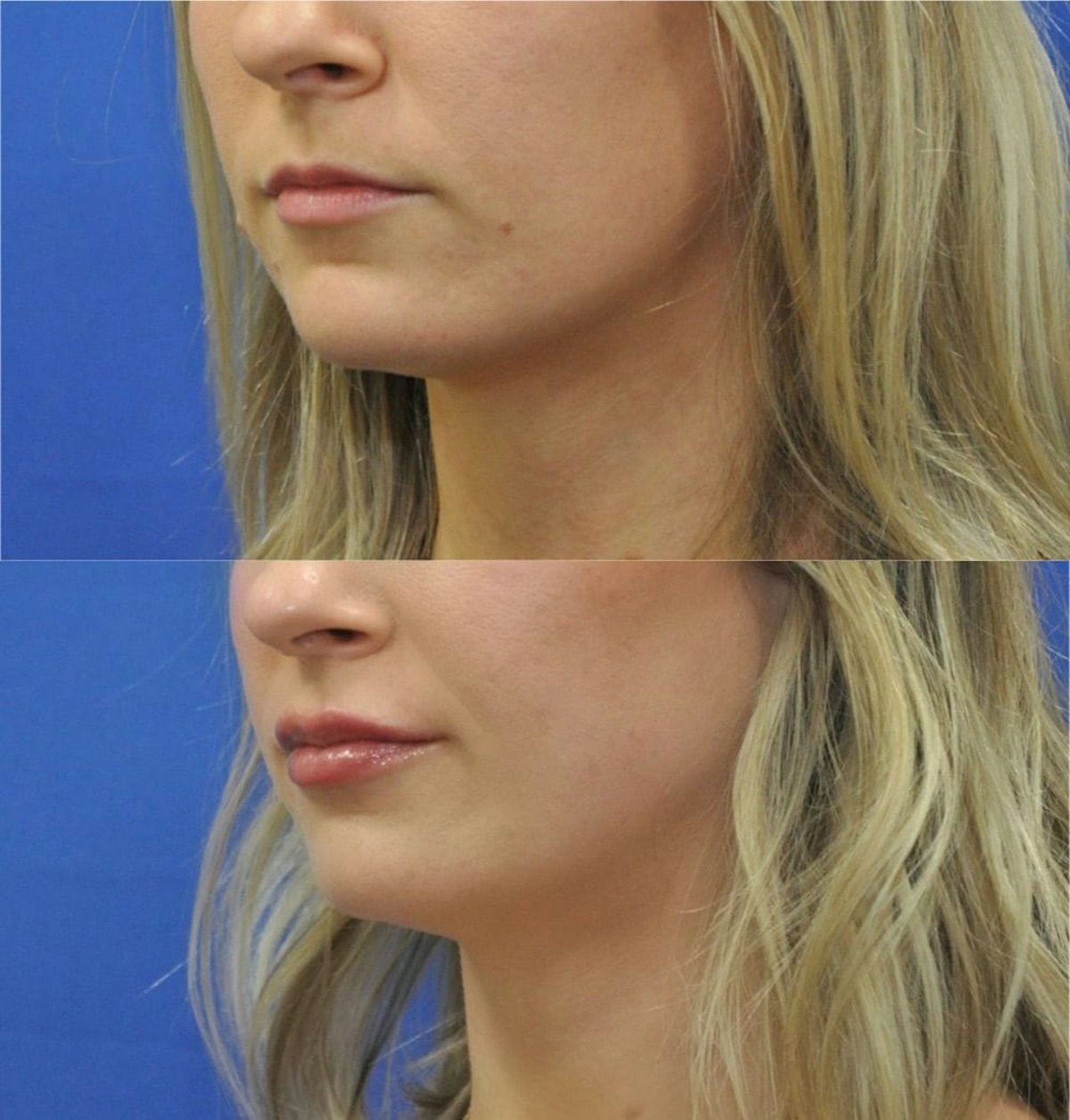 Lip Augmentation Before & After Gallery - Patient 376471 - Image 4