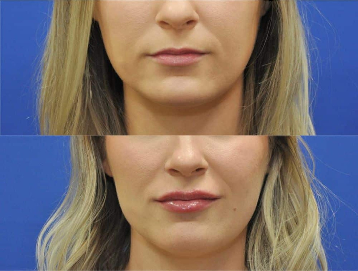 Lip Augmentation Before & After Gallery - Patient 376471 - Image 2